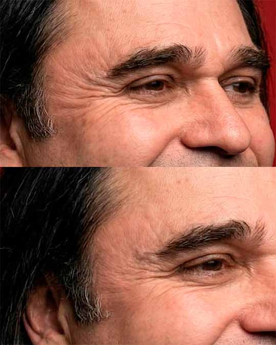 Resultado Botox patas de gallina - antes y después
