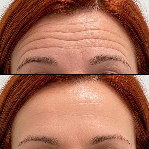 Resultado Botox frente - antes y después