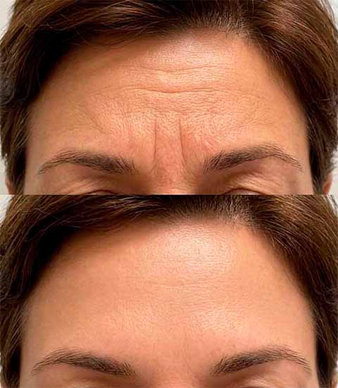 Resultado Botox entrecejo - antes y después
