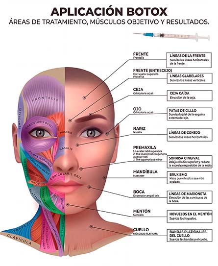 Infografía de áreas tratables con Botox: frente, entrecejo, patas de gallina, nariz, mandíbula, cuello — Clínica Ego Bogotá
